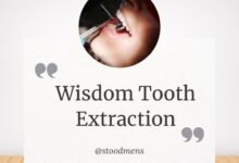wisdom tooth extraction