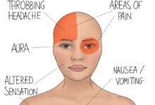 migraine stress management